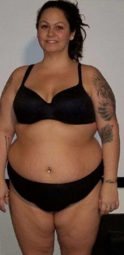 Patients 20-39 Years Old Before & After Gallery - Patient 14494271 - Image 1