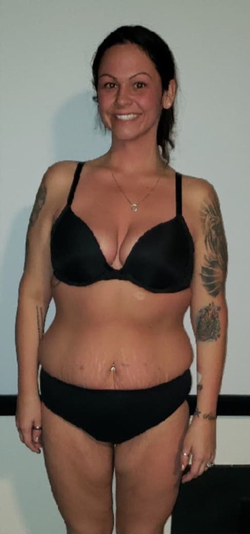 Patients 20-39 Years Old Before & After Gallery - Patient 14494271 - Image 2