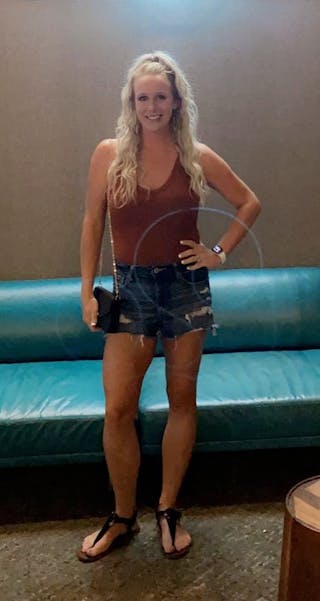 Patients 20-39 Years Old Before & After Gallery - Patient 14494273 - Image 2