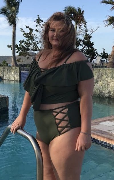 Patients 20-39 Years Old Before & After Gallery - Patient 14494275 - Image 1