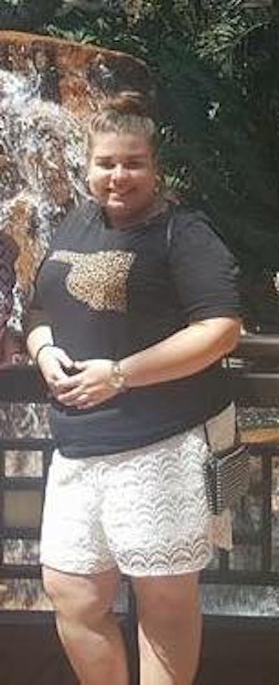 Patients 20-39 Years Old Before & After Gallery - Patient 14494282 - Image 1