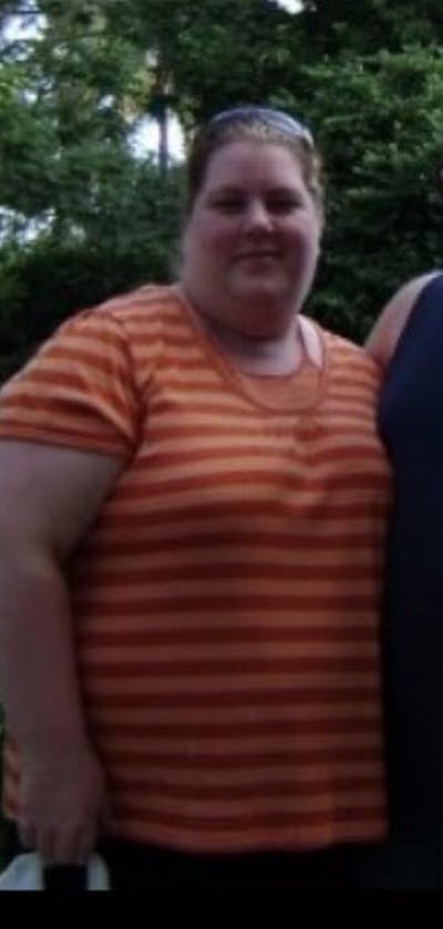 Patients 20-39 Years Old Before & After Gallery - Patient 14494287 - Image 1