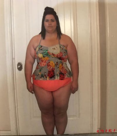 Patients 20-39 Years Old Before & After Gallery - Patient 14494291 - Image 1