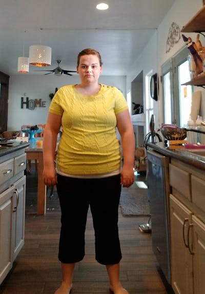 Patients 20-39 Years Old Before & After Gallery - Patient 14494299 - Image 1