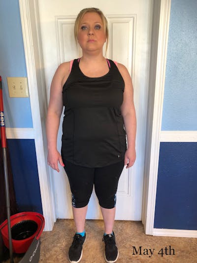 Patients 20-39 Years Old Before & After Gallery - Patient 14494301 - Image 1