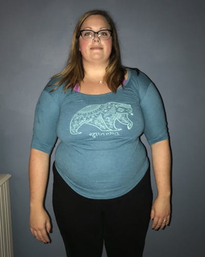 Patients 20-39 Years Old Before & After Gallery - Patient 14494302 - Image 1