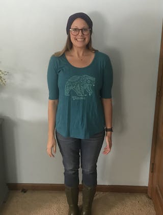 Patients 20-39 Years Old Before & After Gallery - Patient 14494302 - Image 2