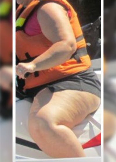 Patients 20-39 Years Old Before & After Gallery - Patient 14494312 - Image 1