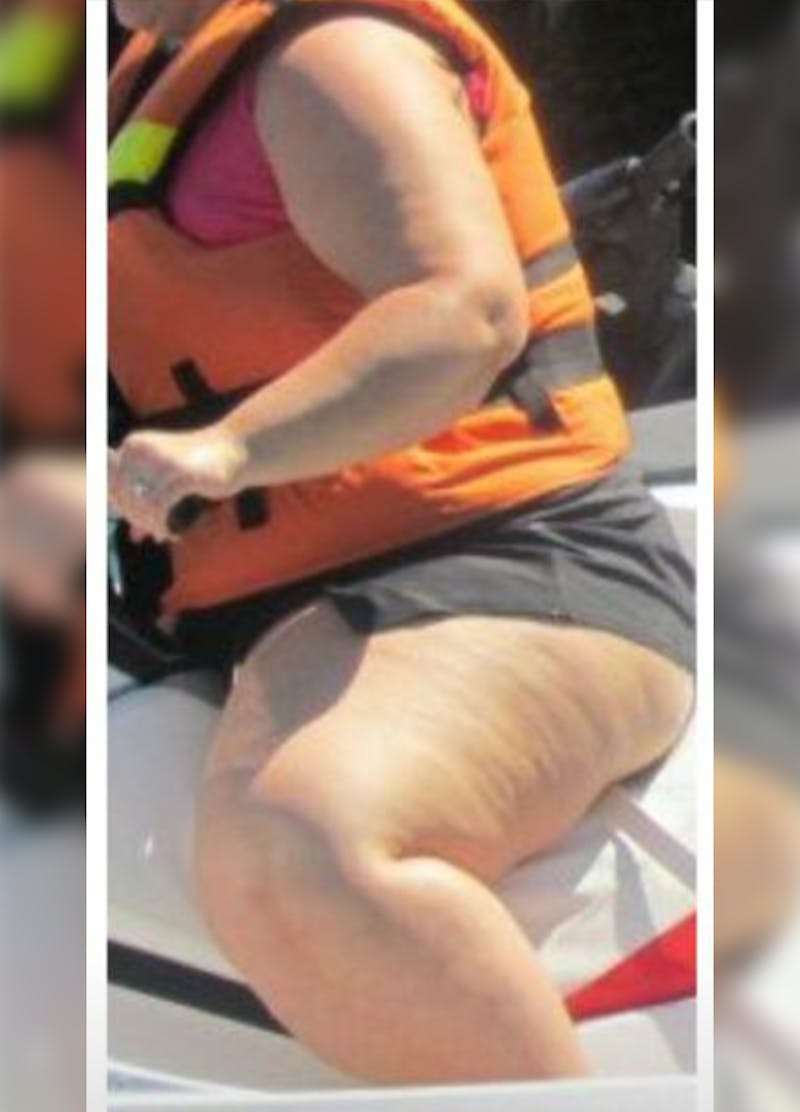 Patients 20-39 Years Old Before & After Gallery - Patient 14494312 - Image 1