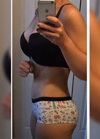 Patients 20-39 Years Old Before & After Gallery - Patient 14494312 - Image 2