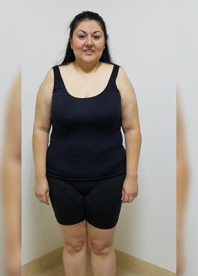 Patients 20-39 Years Old Before & After Gallery - Patient 14494313 - Image 1