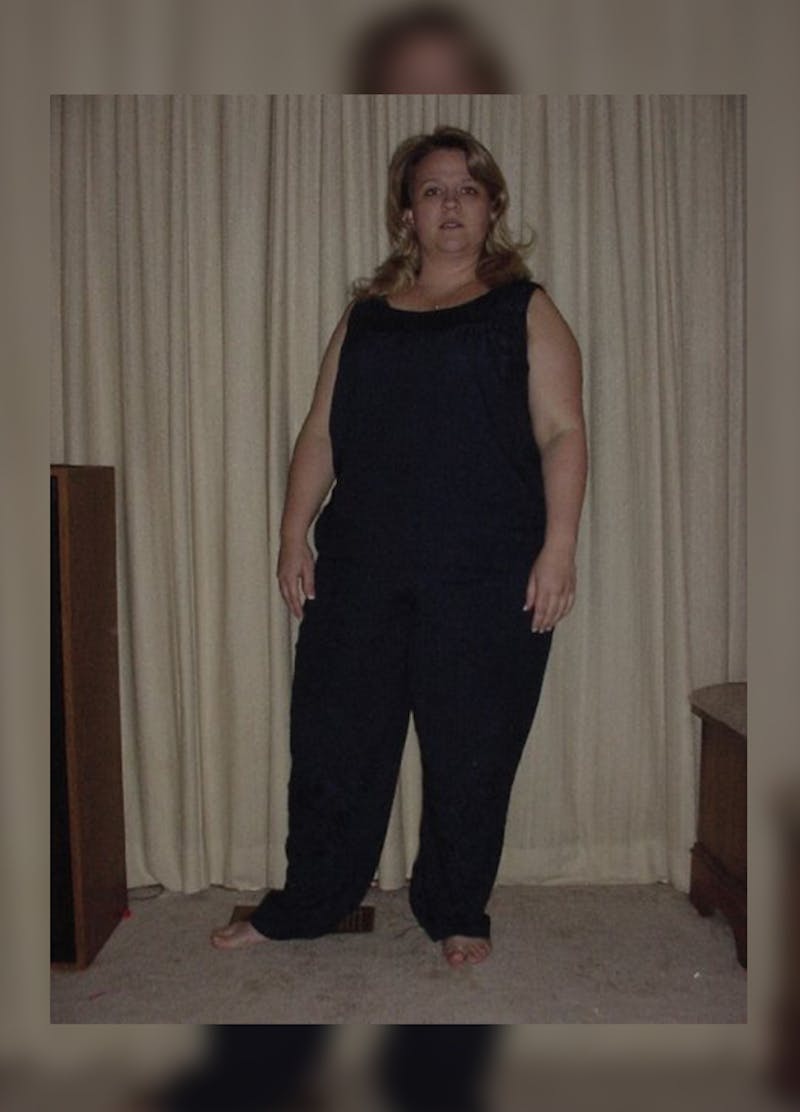 Patients 20-39 Years Old Before & After Gallery - Patient 14494316 - Image 1