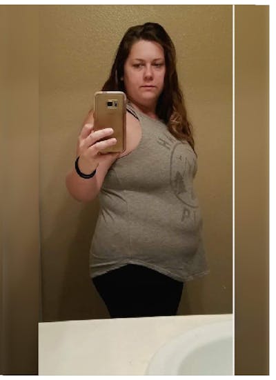 Patients 20-39 Years Old Before & After Gallery - Patient 14494319 - Image 1