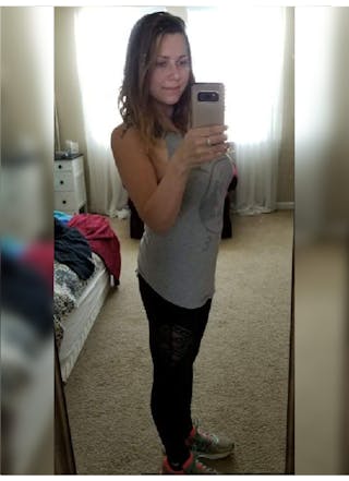 Patients 20-39 Years Old Before & After Gallery - Patient 14494319 - Image 2