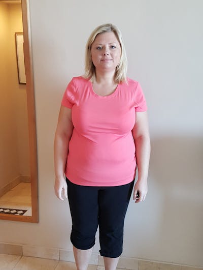 Patients 20-39 Years Old Before & After Gallery - Patient 14494324 - Image 1