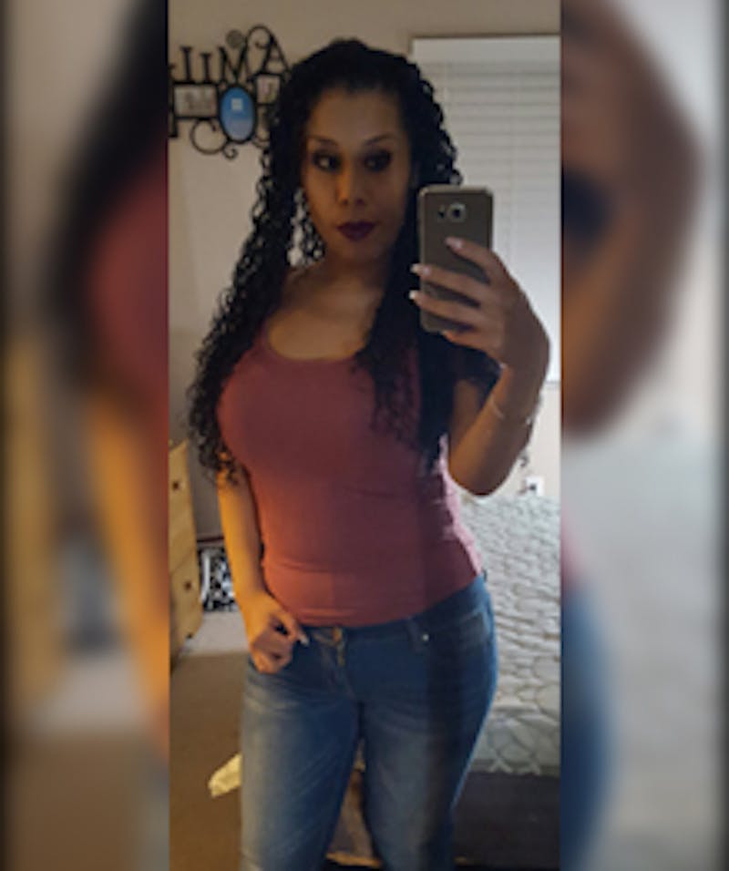 Patients 20-39 Years Old Before & After Gallery - Patient 14494327 - Image 2