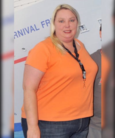 Patients 20-39 Years Old Before & After Gallery - Patient 14494333 - Image 1