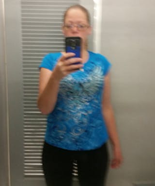 Patients 20-39 Years Old Before & After Gallery - Patient 14494336 - Image 2