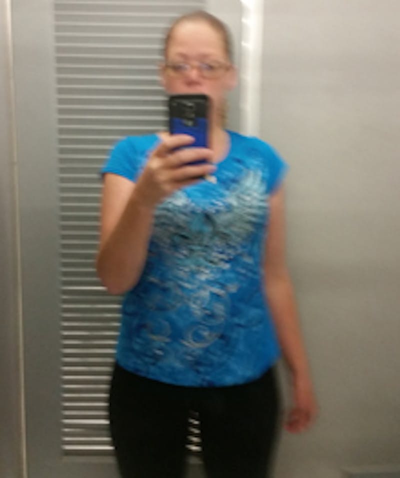 Patients 20-39 Years Old Before & After Gallery - Patient 14494336 - Image 2