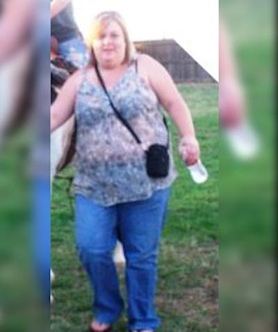 Patients 20-39 Years Old Before & After Gallery - Patient 14494337 - Image 1