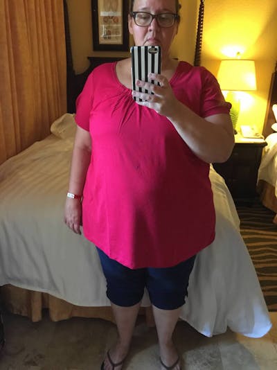 Patients 20-39 Years Old Before & After Gallery - Patient 14494338 - Image 1