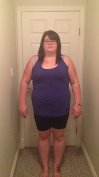 Patients 20-39 Years Old Before & After Gallery - Patient 14494339 - Image 1