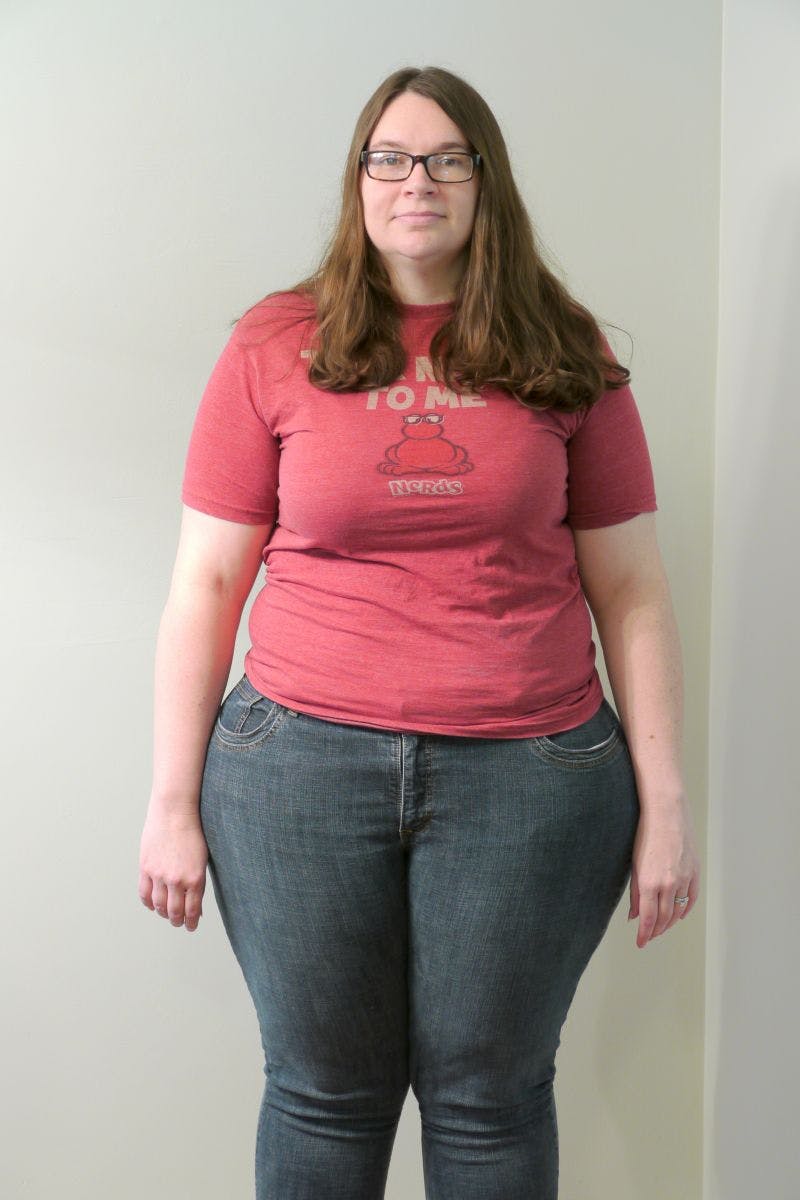 Patients 20-39 Years Old Before & After Gallery - Patient 14494341 - Image 1