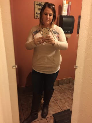 Patients 20-39 Years Old Before & After Gallery - Patient 14494342 - Image 2