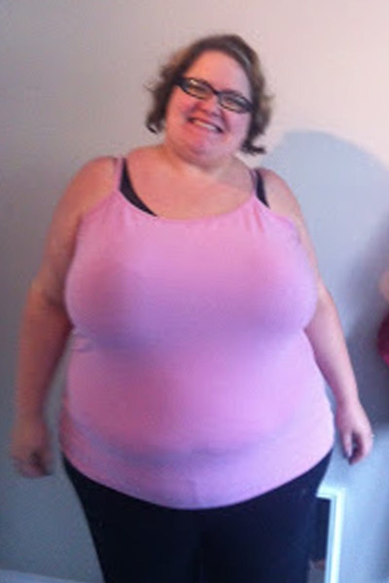 Patients 20-39 Years Old Before & After Gallery - Patient 14494373 - Image 1