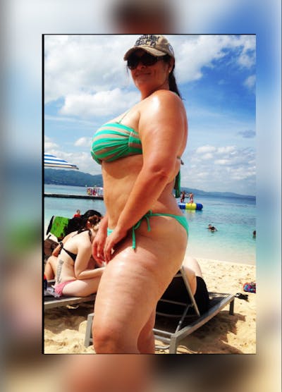 Patients 20-39 Years Old Before & After Gallery - Patient 14494382 - Image 1