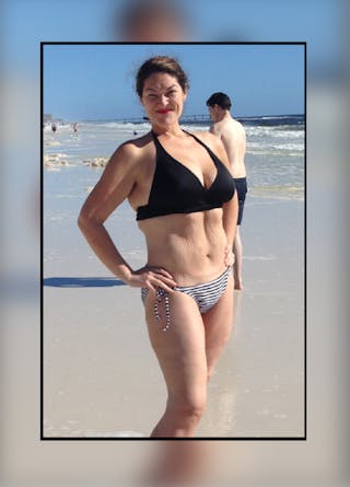 Patients 20-39 Years Old Before & After Gallery - Patient 14494382 - Image 2