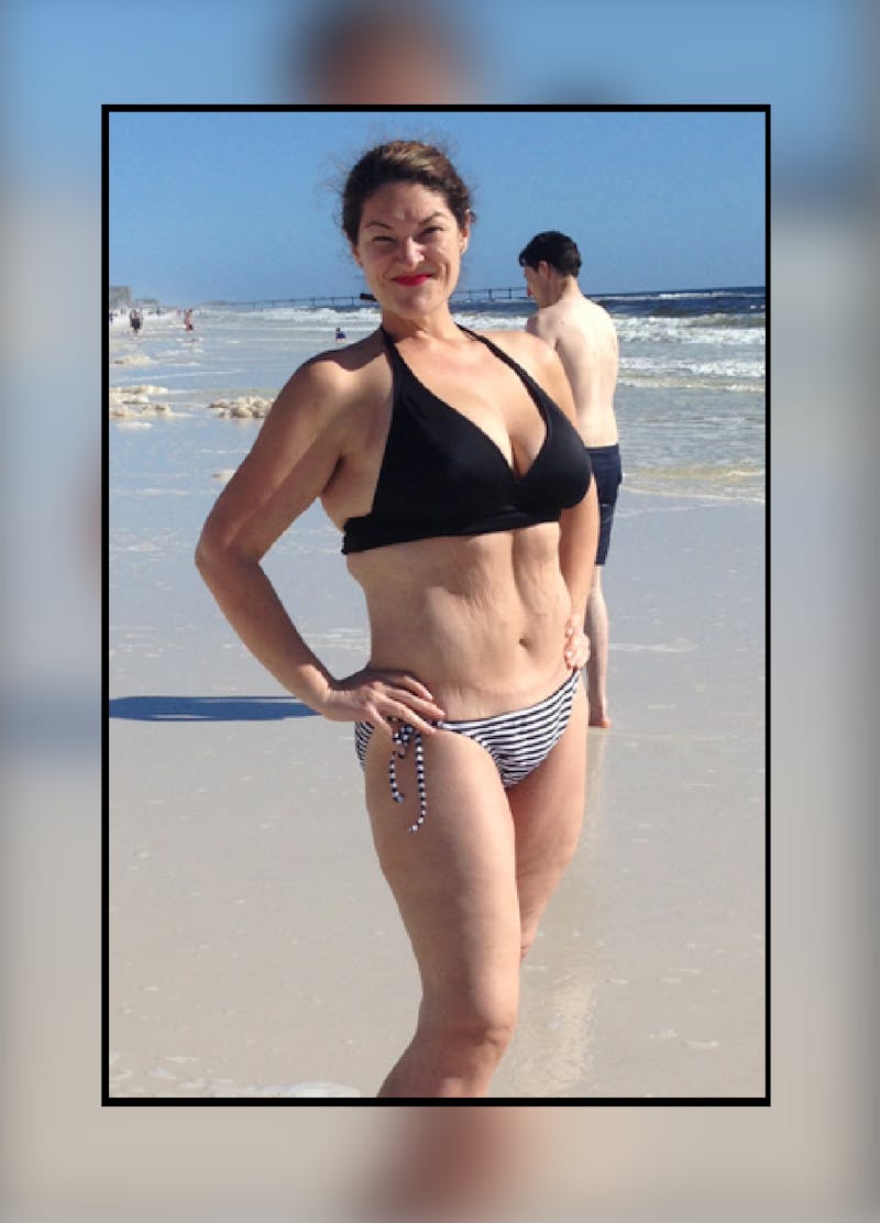 Patients 20-39 Years Old Before & After Gallery - Patient 14494382 - Image 2