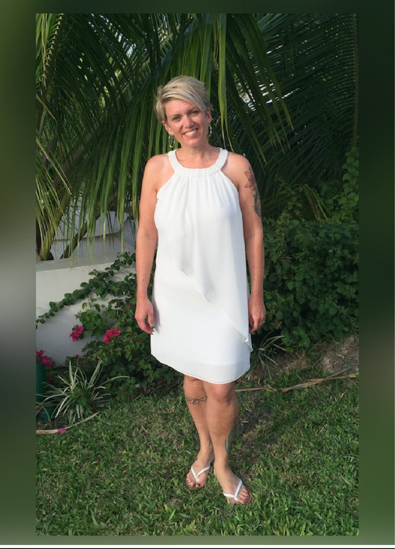 Patients 20-39 Years Old Before & After Gallery - Patient 14494389 - Image 2