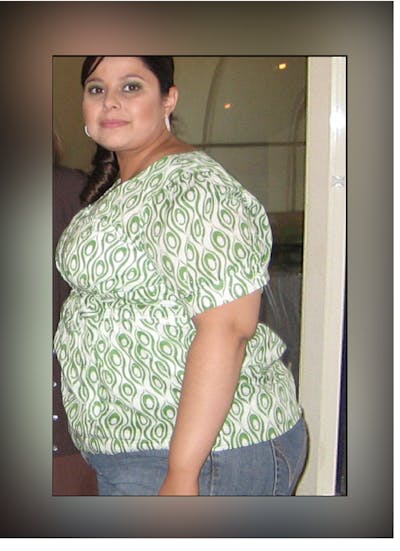 Patients 20-39 Years Old Before & After Gallery - Patient 14494396 - Image 1