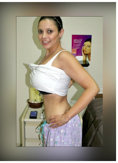 Patients 20-39 Years Old Before & After Gallery - Patient 14494396 - Image 2