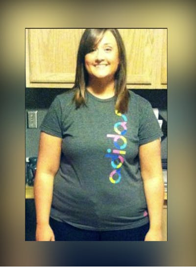 Patients 20-39 Years Old Before & After Gallery - Patient 14494400 - Image 1