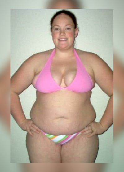 Patients 20-39 Years Old Before & After Gallery - Patient 14494406 - Image 1