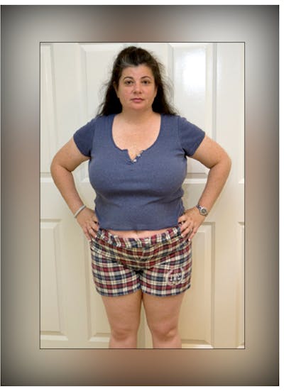 Patients 20-39 Years Old Before & After Gallery - Patient 14494407 - Image 1