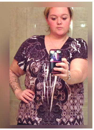 Patients 20-39 Years Old Before & After Gallery - Patient 14494413 - Image 1