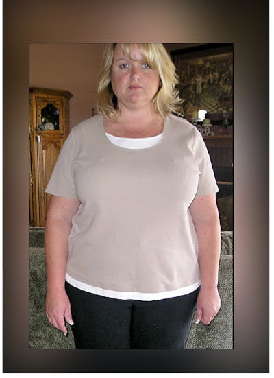 Patients 20-39 Years Old Before & After Gallery - Patient 14494415 - Image 1