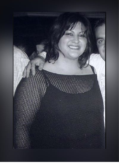 Patients 20-39 Years Old Before & After Gallery - Patient 14494418 - Image 1