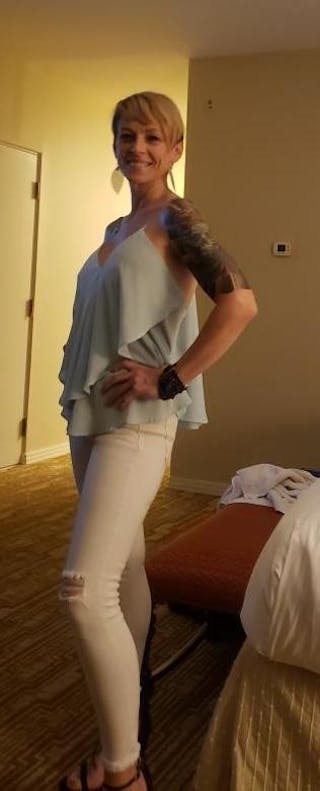 Patients 40-59 Years Old Before & After Gallery - Patient 14494449 - Image 2