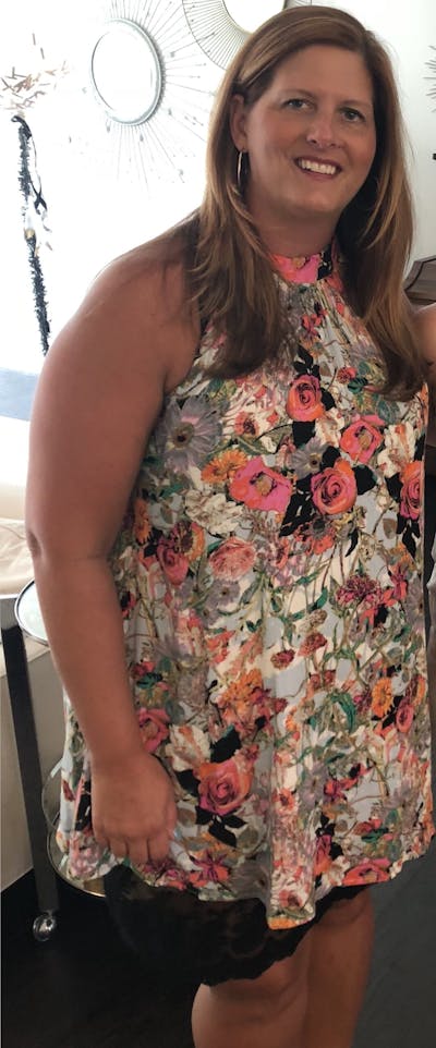 Patients 40-59 Years Old Before & After Gallery - Patient 14494450 - Image 1