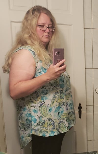 Patients 40-59 Years Old Before & After Gallery - Patient 14494455 - Image 1