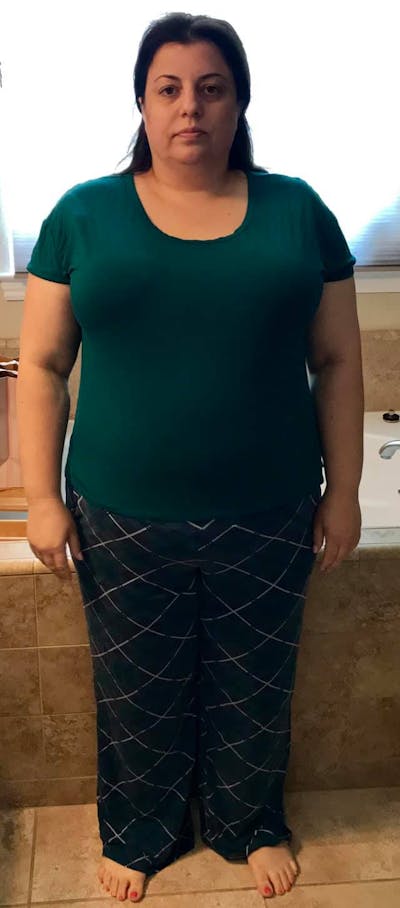 Patients 40-59 Years Old Before & After Gallery - Patient 14494470 - Image 1