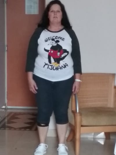 Patients 40-59 Years Old Before & After Gallery - Patient 14494478 - Image 1