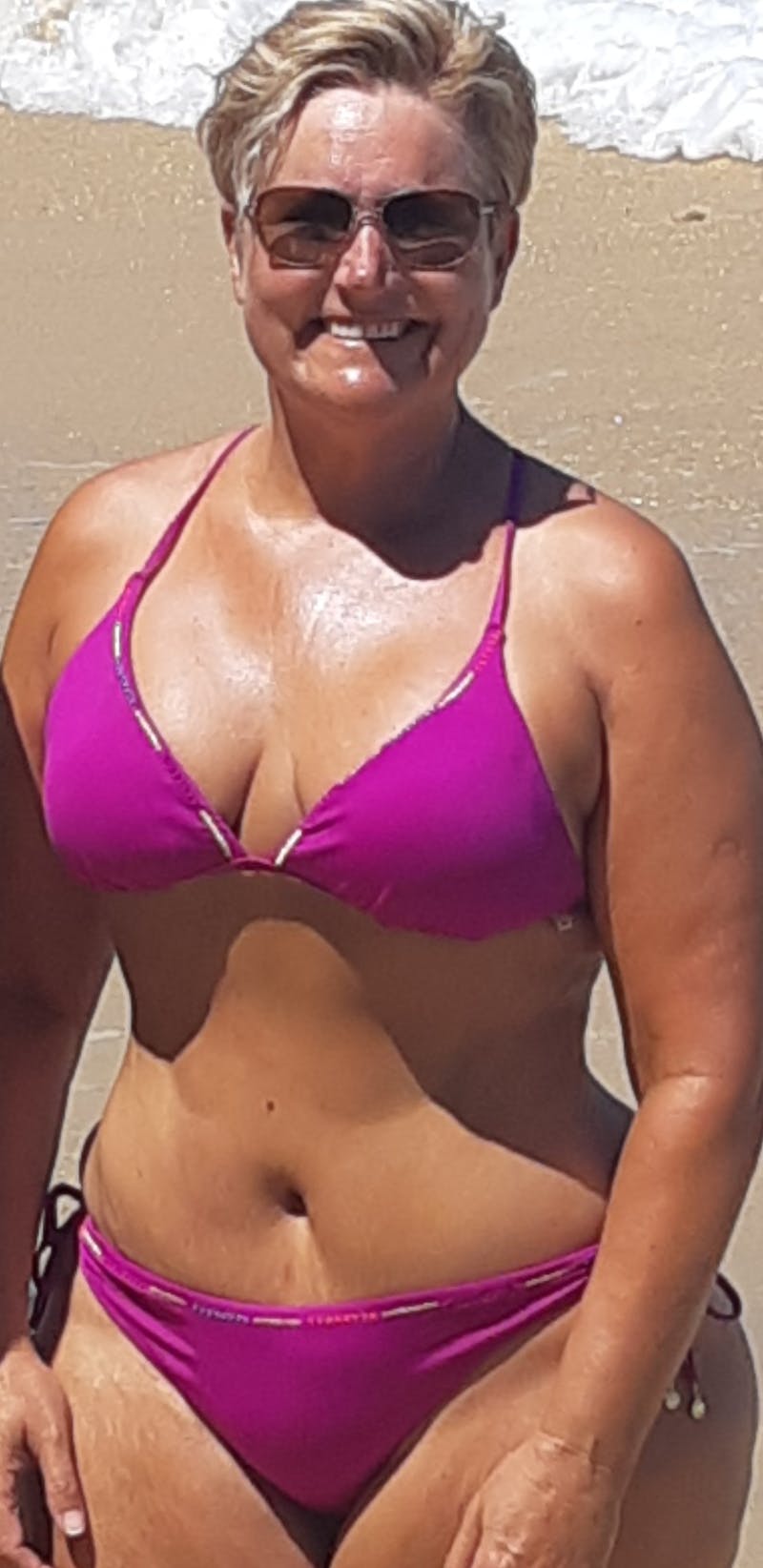 Patients 40-59 Years Old Before & After Gallery - Patient 14494491 - Image 2