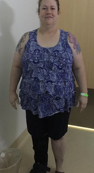 Patients 40-59 Years Old Before & After Gallery - Patient 14494492 - Image 1