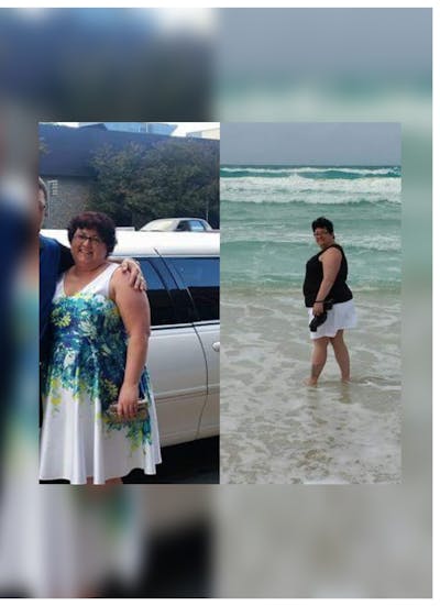 Patients 40-59 Years Old Before & After Gallery - Patient 14494497 - Image 1