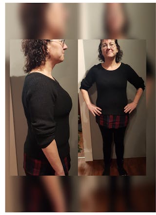 Patients 40-59 Years Old Before & After Gallery - Patient 14494497 - Image 2